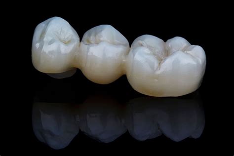 Bionanocomposite: Materiale rivoluzionario per Impianti Odontoiatrici e Protesi Articolari?