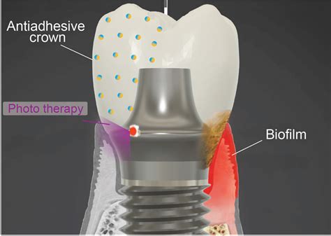  Junonite: Biocompatibilità Avanzata per Impianti Dentali di Nuova Generazione!