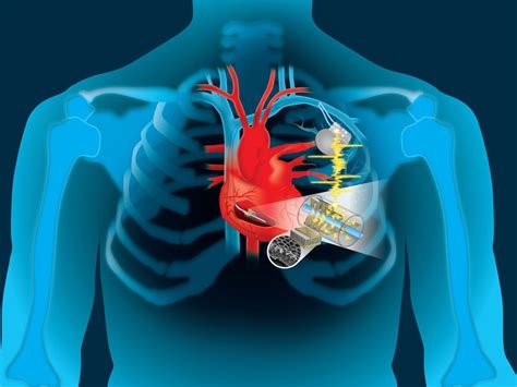  Liquid Crystals per Impianti Cardiaci Innovativi: Il Futuro della Medicina?