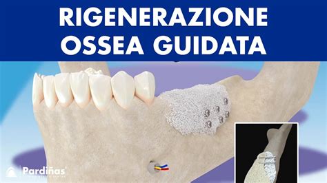  Osseointegratable Titanium: Rivoluzionando L’Impiantistica Dentale e l’Ortopedia