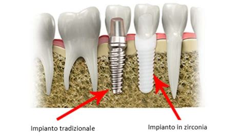  Ossido di Zirconio: Una Rivoluzione Biocompatibile per Impianti Dentali di Ultima Generazione!