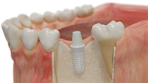  ZIRCONIA: Un Biomateriale Resistente e Biocompatibile per Impianti Dentali di Lunga Durata!