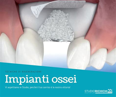  Zeolite: Un Rivoluzionario Biomateriale per Impianti Dentali Innovativi e Ricostruzione Ossea